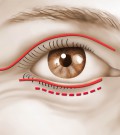 blepharoplastie