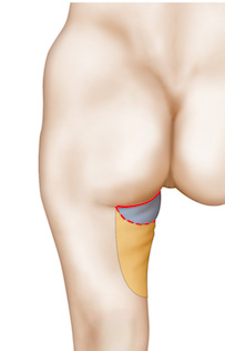 18_-_lifting_face_interne_cuisse