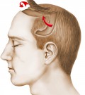 chirurgie_de_la_calvitie