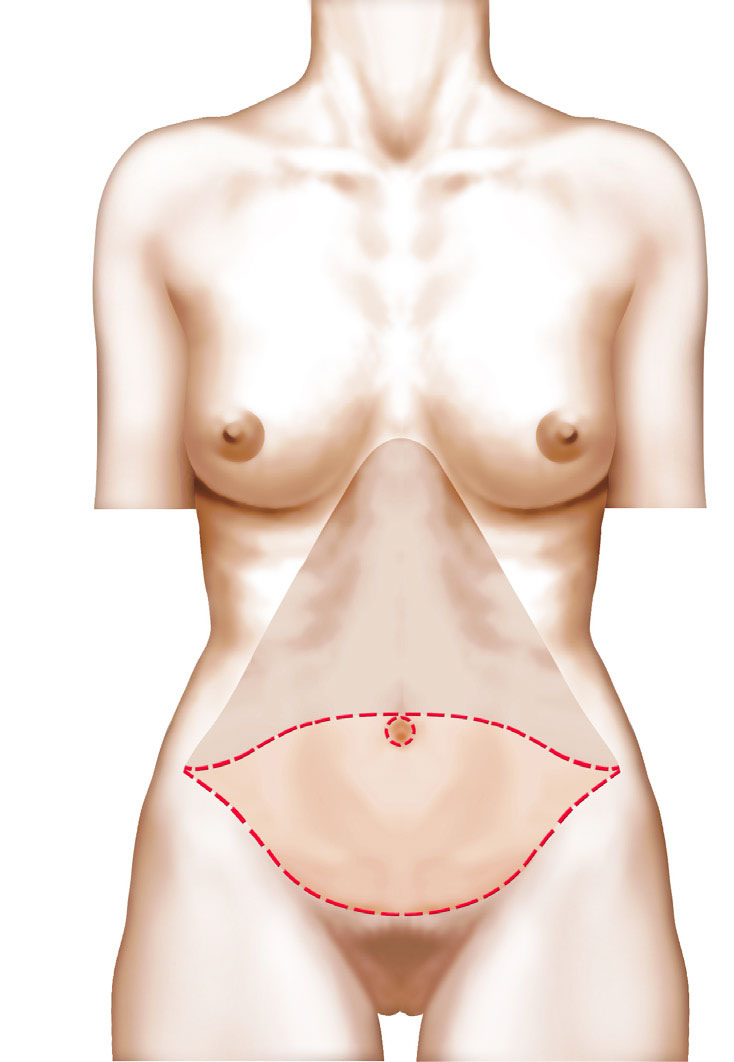 L'abdominoplastie : chirurgie esthétique du ventre - Dr Sylvie Abraham