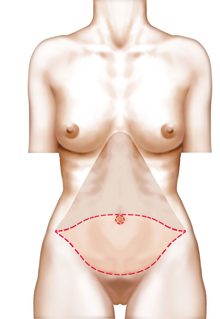 Gaine Après Abdominoplastie